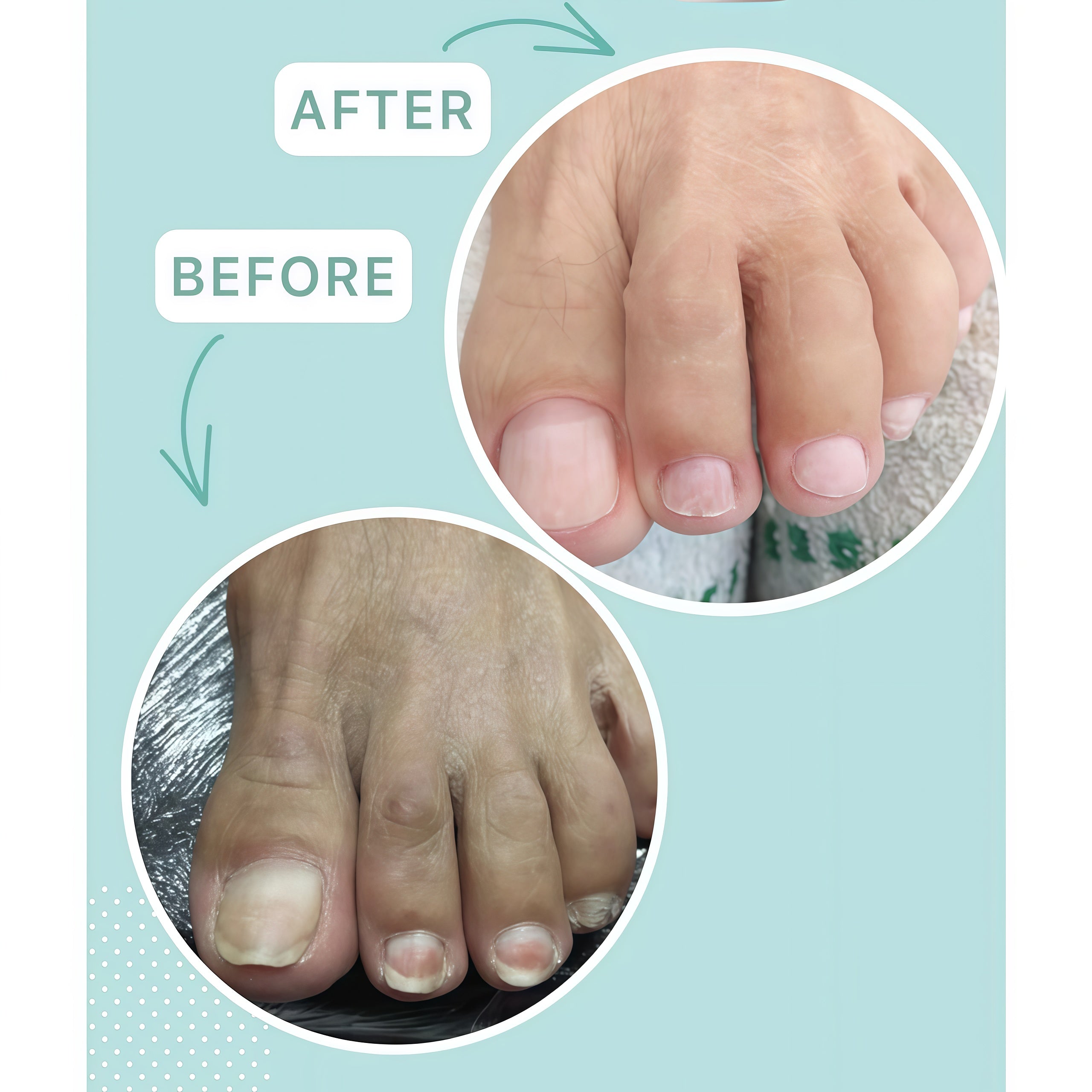 Shelly Stop Onycholysis Nail Recovery Oil with Tea Tree, Eucalyptus & Farnesol 30 ml