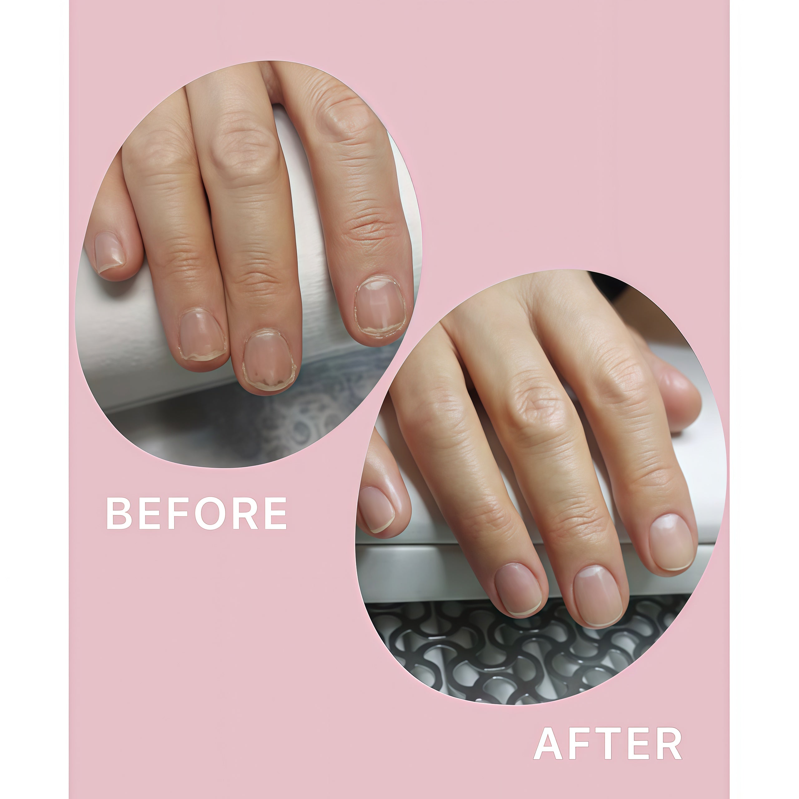 Shelly Stop Onycholysis Nail Recovery Oil with Tea Tree, Eucalyptus & Farnesol 30 ml